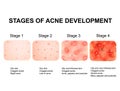 Stages of development of acne. Inflamed skin with scars, acne and pimples. The texture of inflamed skin, and acne and