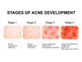 Stages of development of acne. Inflamed skin with scars, acne and pimples. The texture of inflamed skin, and acne and