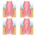 stages of development of hemorrhoids.