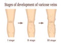 Stages of development of varicose veins