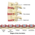 Stages of disc herniation spine and disc anatomy 3d medical vector illustration