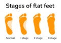 Stages of flat feet Royalty Free Stock Photo