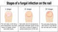 Stages of a fungal infection on the nail