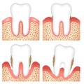 Stages of gum disease infographic illustration. dental and oral care concept