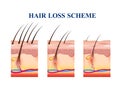 Hair Loss Scheme Royalty Free Stock Photo