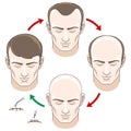 Stages of hair loss, treatment and transplantation Royalty Free Stock Photo