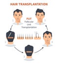 Stages of hair transplantation FUT Follicular Unit Royalty Free Stock Photo