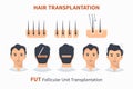 Stages of hair transplantation FUT Follicular Unit Royalty Free Stock Photo