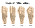 Stages of hallux valgus