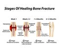 Stages Of Healing Bone Fracture. Formation of callus. The bone fracture. Infographics. Vector illustration on isolated Royalty Free Stock Photo