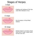 Stages of Herpes