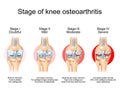 Stages of knee osteoarthritis Royalty Free Stock Photo