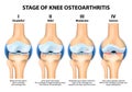 Stages of knee Osteoarthritis (OA). Royalty Free Stock Photo
