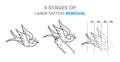 4 Stages of laser tattoo removal illustration, vector icons