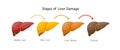 Stages of liver damage. Liver Disease. Healthy, fatty, fibrosis and Cirrhosis.