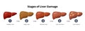 Stages of liver damage from healthy, fatty liver, fibrosis, cirrhosis to liver cancer. Medical infographic, liver