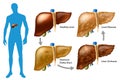 Stages of liver damage