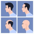 Stages of male pattern baldness. Hair loss. Alopecia. Royalty Free Stock Photo