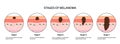 Melanoma stages poster