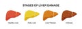 Stages of nonalcoholic liver damage. Healthy, fatty and cirrhosis. Liver Disease.