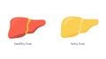 Stages of nonalcoholic liver damage. Healthy and unhealthy fatty human organ. Liver Disease. Vector illustration in flat