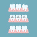 Stages of orthodontic treatment braces on teeth. Alignment of bite of teeth, dental row with braces