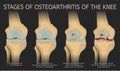Stages of osteoarthritis of the knee Royalty Free Stock Photo