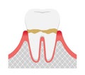 The stages of periodontitis disease illustration / Gingivitis