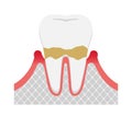 The stages of periodontitis disease illustration / Mild periodontitis