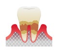 The stages of periodontitis disease illustration / Moderate periodontitis