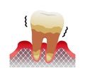 The stages of periodontitis disease  illustration / Severe periodontitis Royalty Free Stock Photo