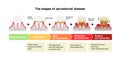 The stages of periodontitis disease illustration