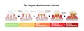 The stages of periodontitis disease illustration