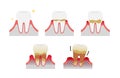 The stages of periodontitis disease illustration