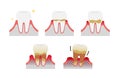 The stages of periodontitis disease illustration Royalty Free Stock Photo