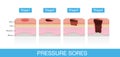 Stages of Pressure Sores