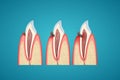 Stages progress caries on human canine