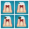 Stages progress caries on human teeth