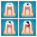 Stages progress dental caries