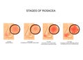 Stages of rosacea