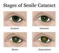 Stages of Senile Cataracts Royalty Free Stock Photo