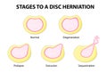 Stages to a disc herniation Royalty Free Stock Photo