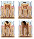 Stages of tooth caries Royalty Free Stock Photo