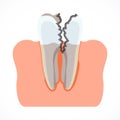 Stages of tooth decay with caries. Dentistry and oral care