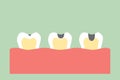 Stages of tooth decay Royalty Free Stock Photo