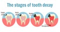 The stages of tooth decay infographic. Dental toothache symbol