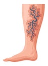 Stages or types of varicose veins development. Medical poster or disease infographic. Image of diseased legs. Vector