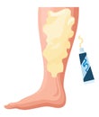 Stages or types of varicose veins development. Medical poster or disease infographic. Image of diseased legs. Vector