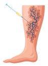 Stages or types of varicose veins development. Medical poster or disease infographic. Image of diseased legs. Vector