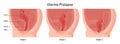 Stages of uterine prolapse. Pelvic floor muscles weakening, Support